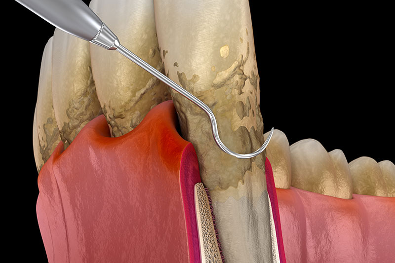 Periodontal Care in Anna